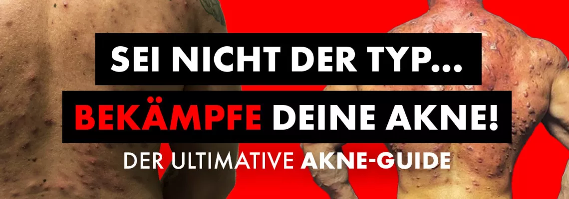 AKNE UND STEROIDE